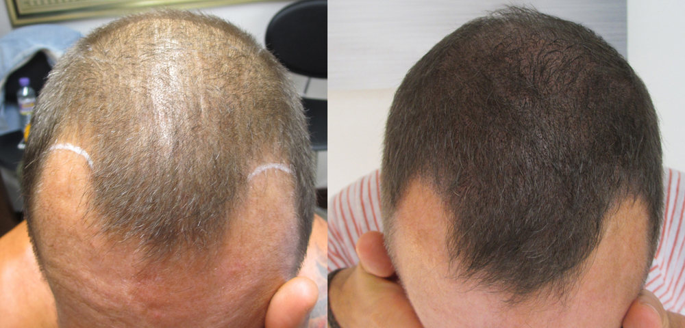 how to regrow hair in bald patches naturally
